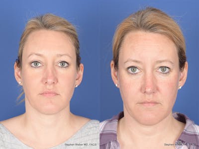 Revision Rhinoplasty Before & After Gallery - Patient 290268 - Image 1