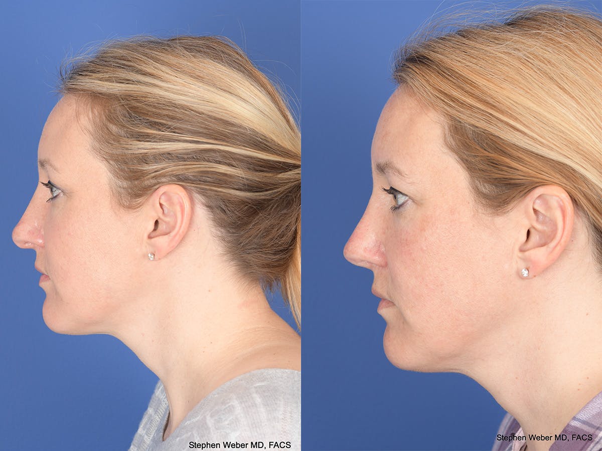 Revision Rhinoplasty Before & After Gallery - Patient 290268 - Image 2