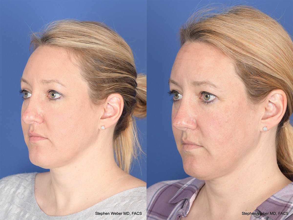 Revision Rhinoplasty Before & After Gallery - Patient 290268 - Image 3
