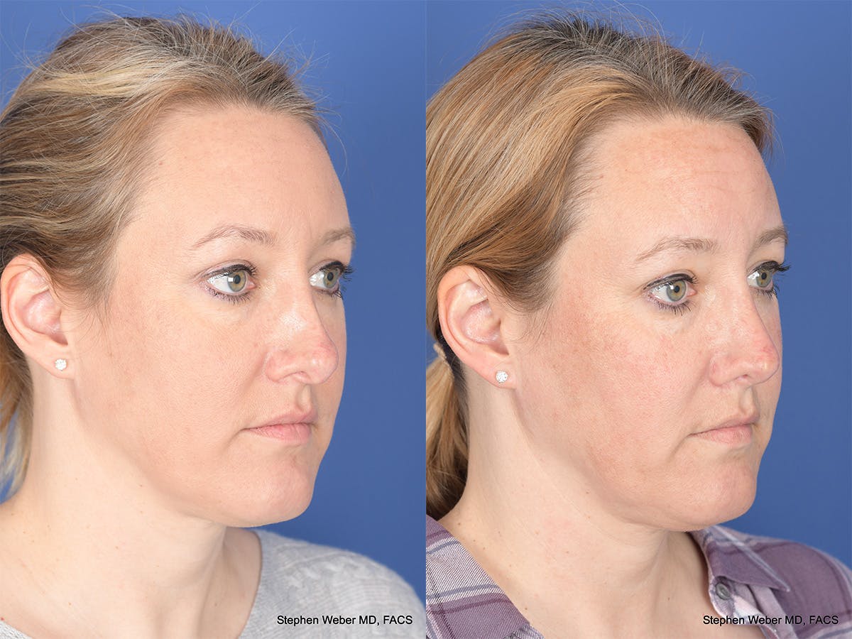 Revision Rhinoplasty Before & After Gallery - Patient 290268 - Image 4
