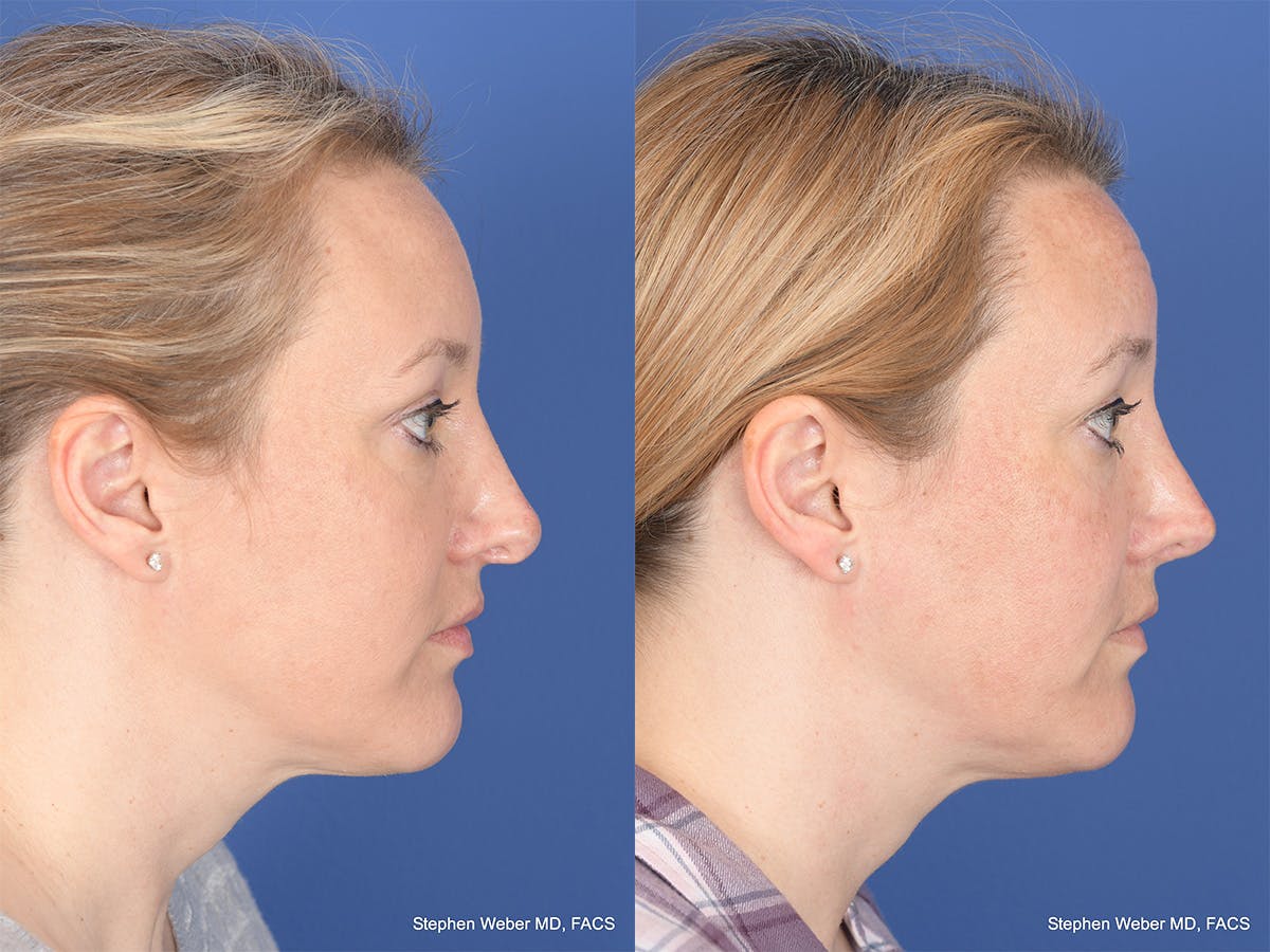Revision Rhinoplasty Before & After Gallery - Patient 290268 - Image 5