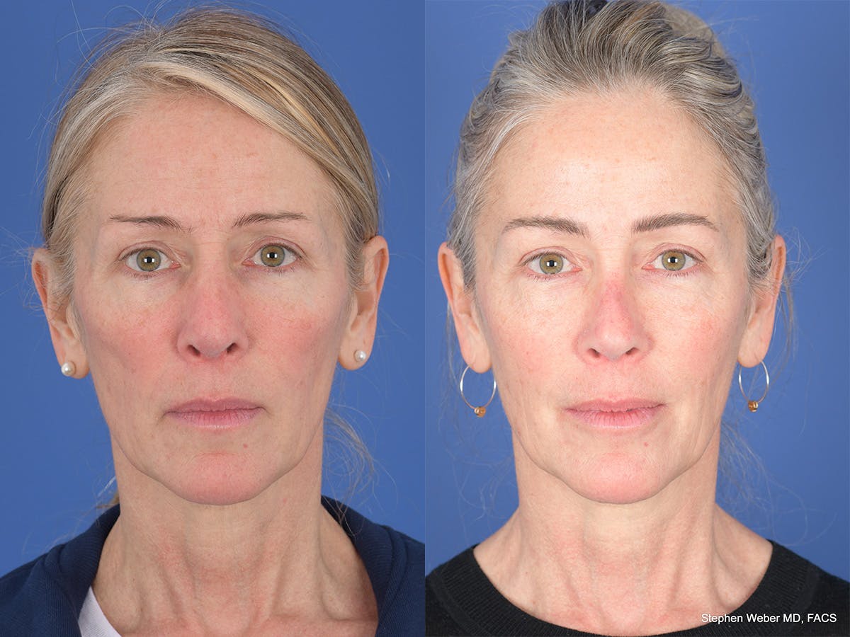 Revision Rhinoplasty Before & After Gallery - Patient 138846 - Image 1