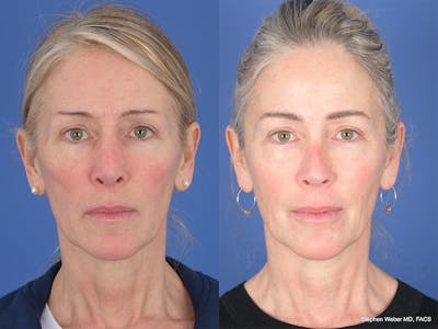 Revision Rhinoplasty Before & After Gallery - Patient 138846 - Image 1