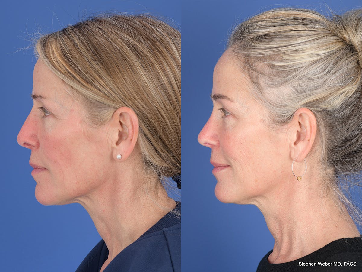 Revision Rhinoplasty Before & After Gallery - Patient 138846 - Image 2