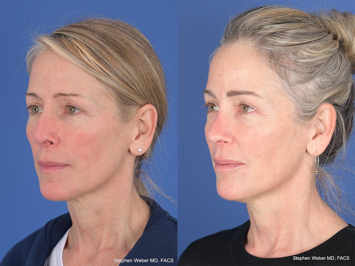 Revision Rhinoplasty Before & After Gallery - Patient 138846 - Image 3