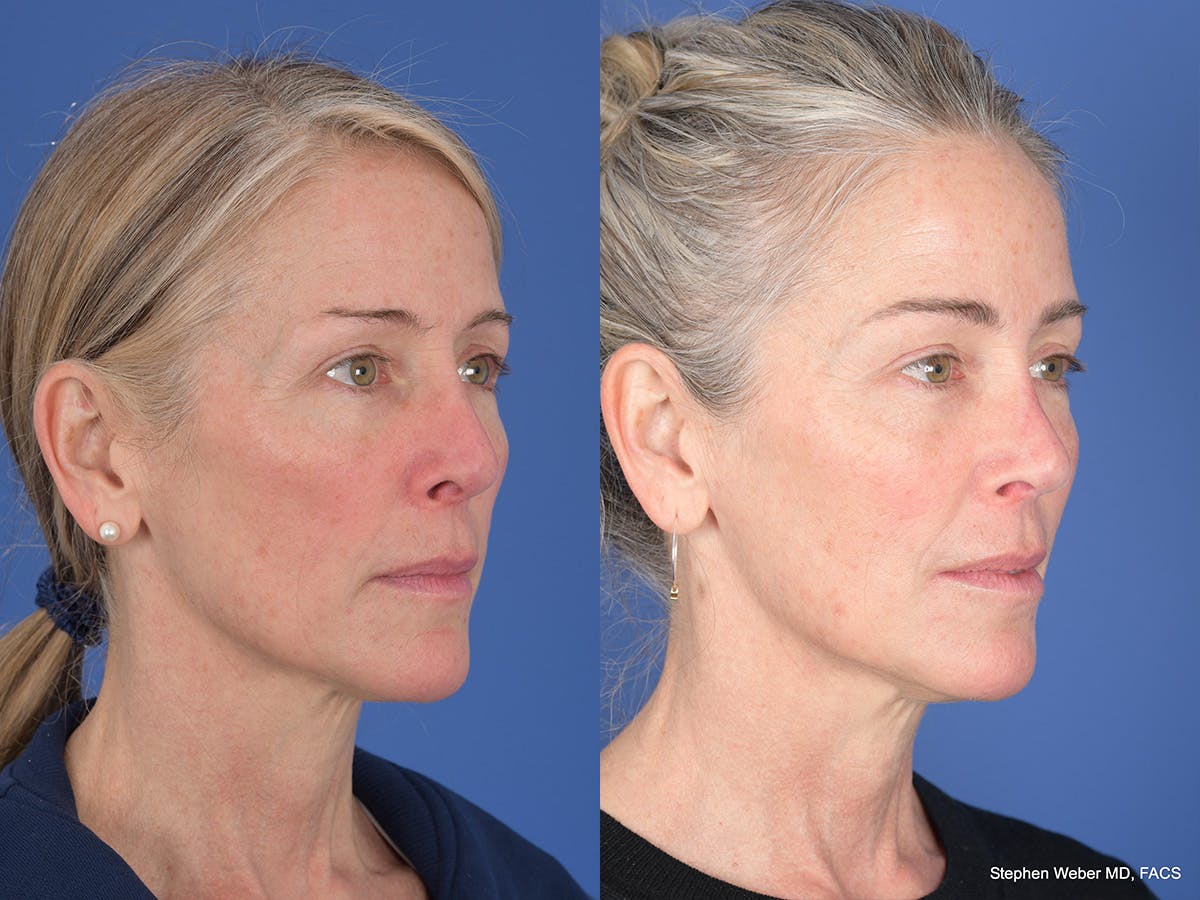 Revision Rhinoplasty Before & After Gallery - Patient 138846 - Image 4