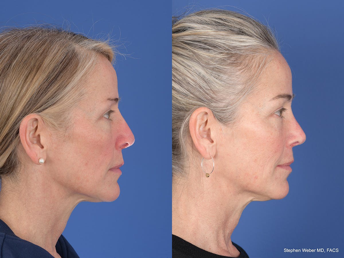 Revision Rhinoplasty Before & After Gallery - Patient 138846 - Image 5