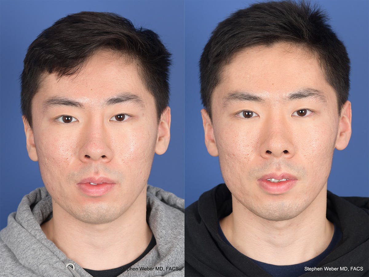 Revision Rhinoplasty Before & After Gallery - Patient 384235 - Image 1