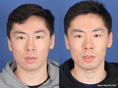 Revision Rhinoplasty Before & After Gallery - Patient 384235 - Image 1