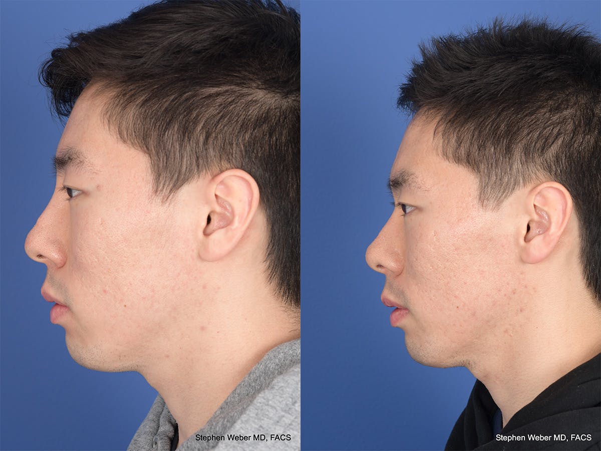 Revision Rhinoplasty Before & After Gallery - Patient 384235 - Image 2