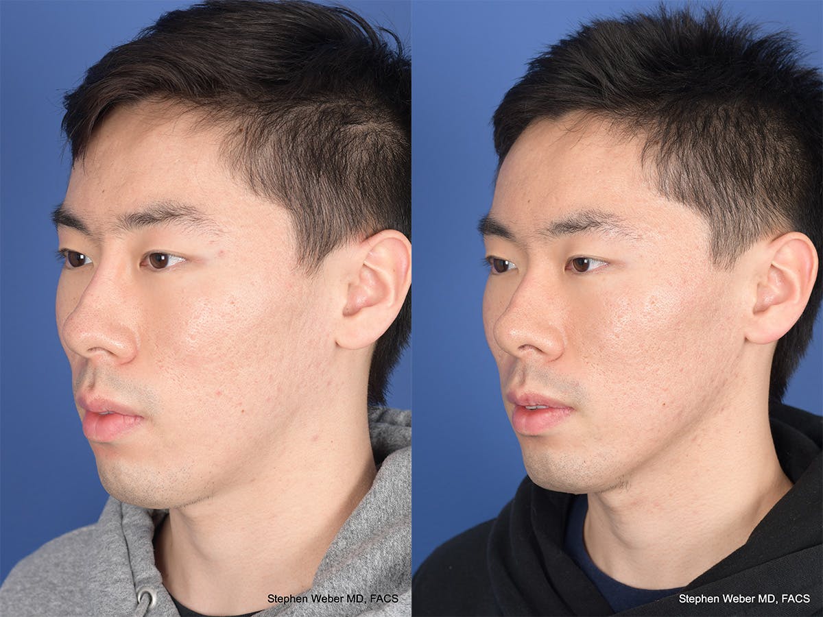 Revision Rhinoplasty Before & After Gallery - Patient 384235 - Image 3