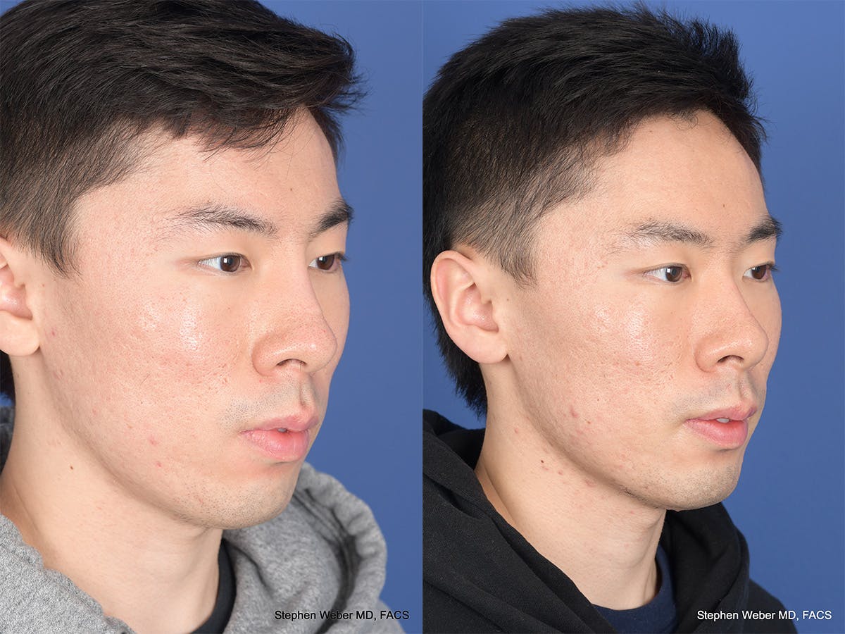 Revision Rhinoplasty Before & After Gallery - Patient 384235 - Image 4