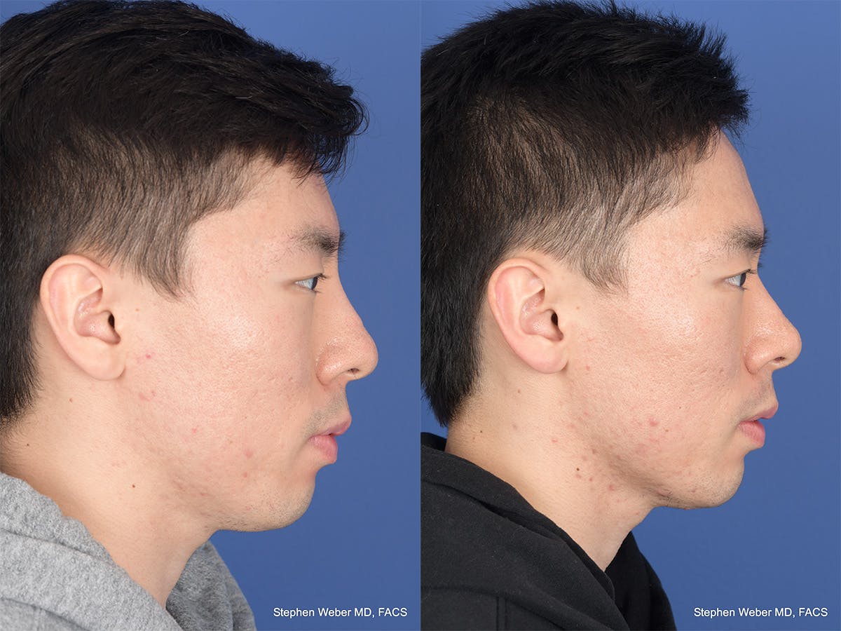 Revision Rhinoplasty Before & After Gallery - Patient 384235 - Image 5