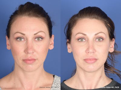 Revision Rhinoplasty Before & After Gallery - Patient 132948 - Image 1