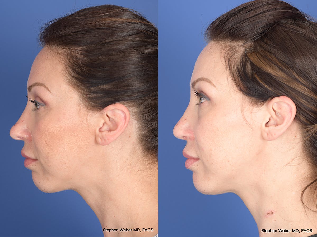Revision Rhinoplasty Before & After Gallery - Patient 132948 - Image 2