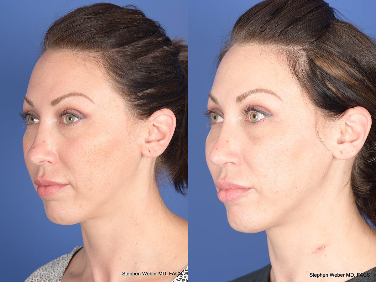 Revision Rhinoplasty Before & After Gallery - Patient 132948 - Image 3