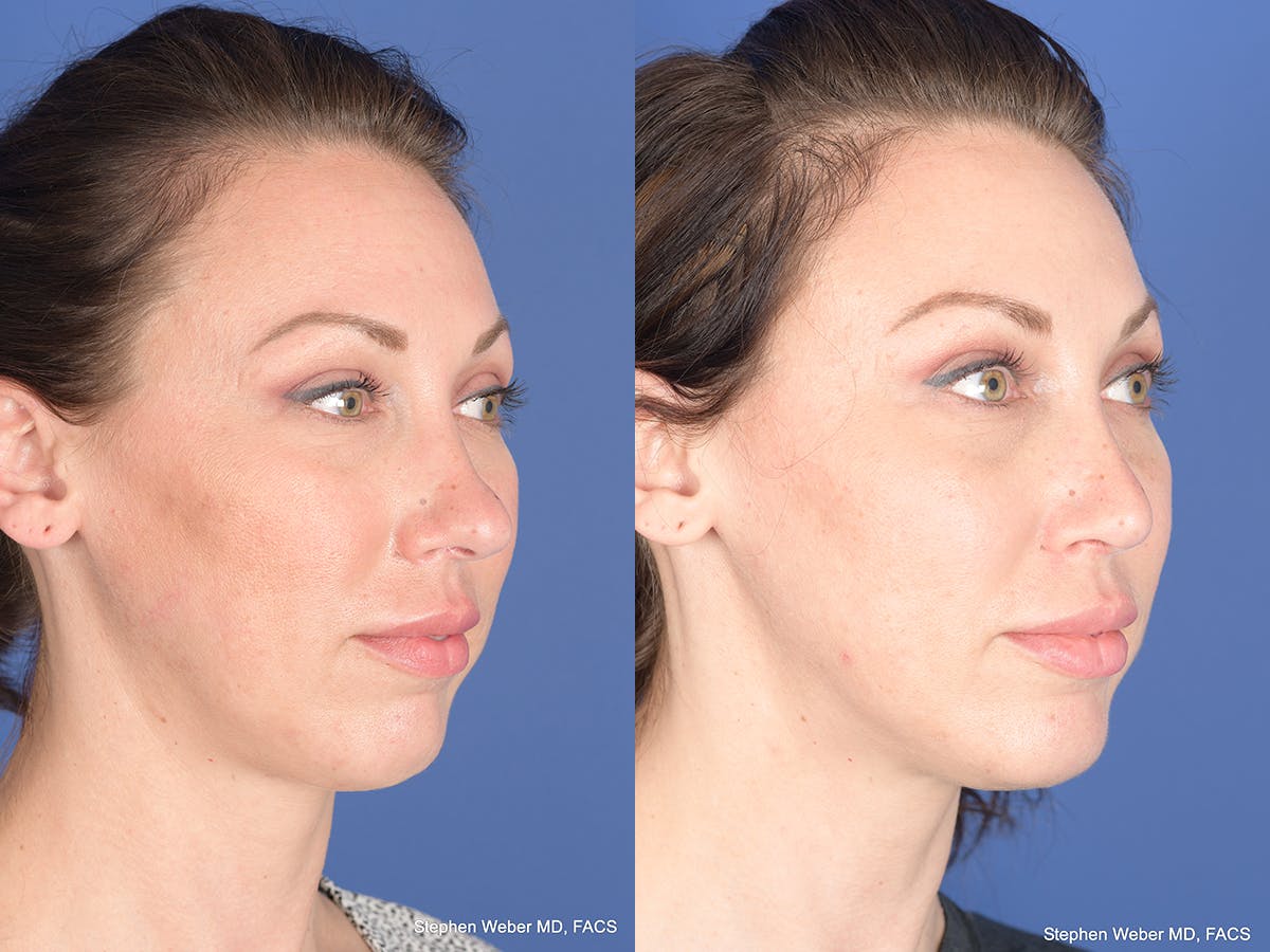 Revision Rhinoplasty Before & After Gallery - Patient 132948 - Image 4