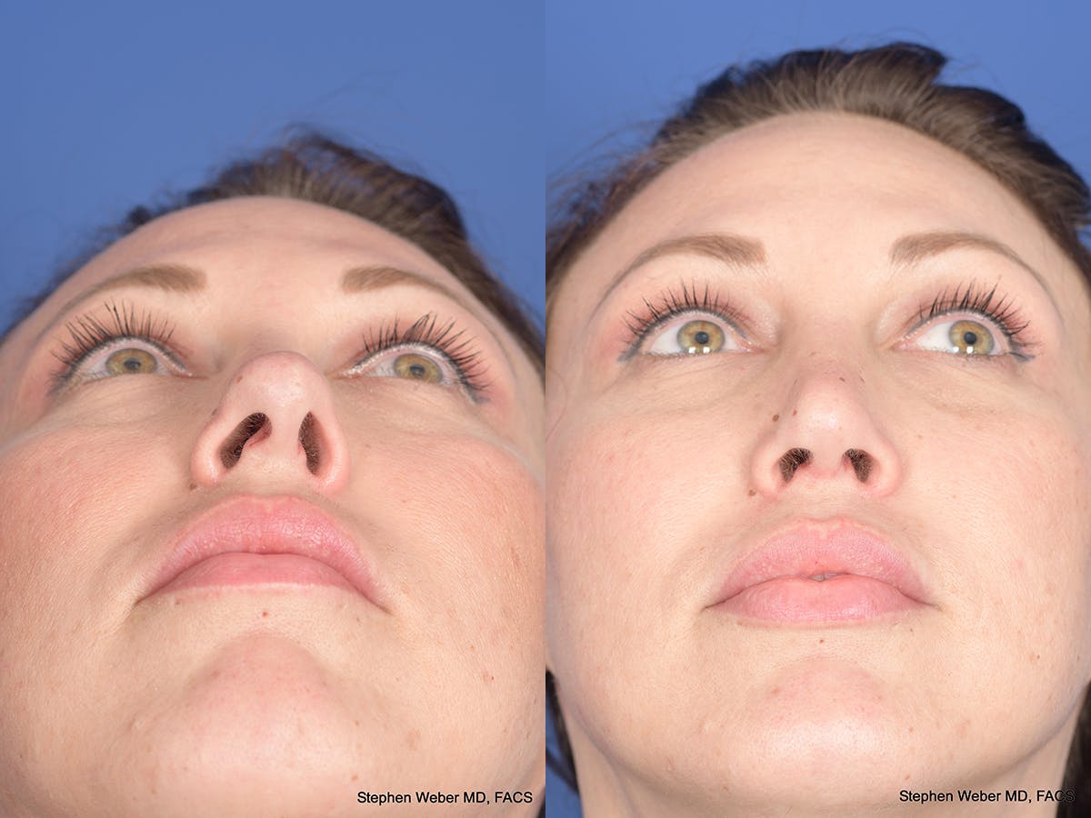 Revision Rhinoplasty Before & After Gallery - Patient 132948 - Image 6