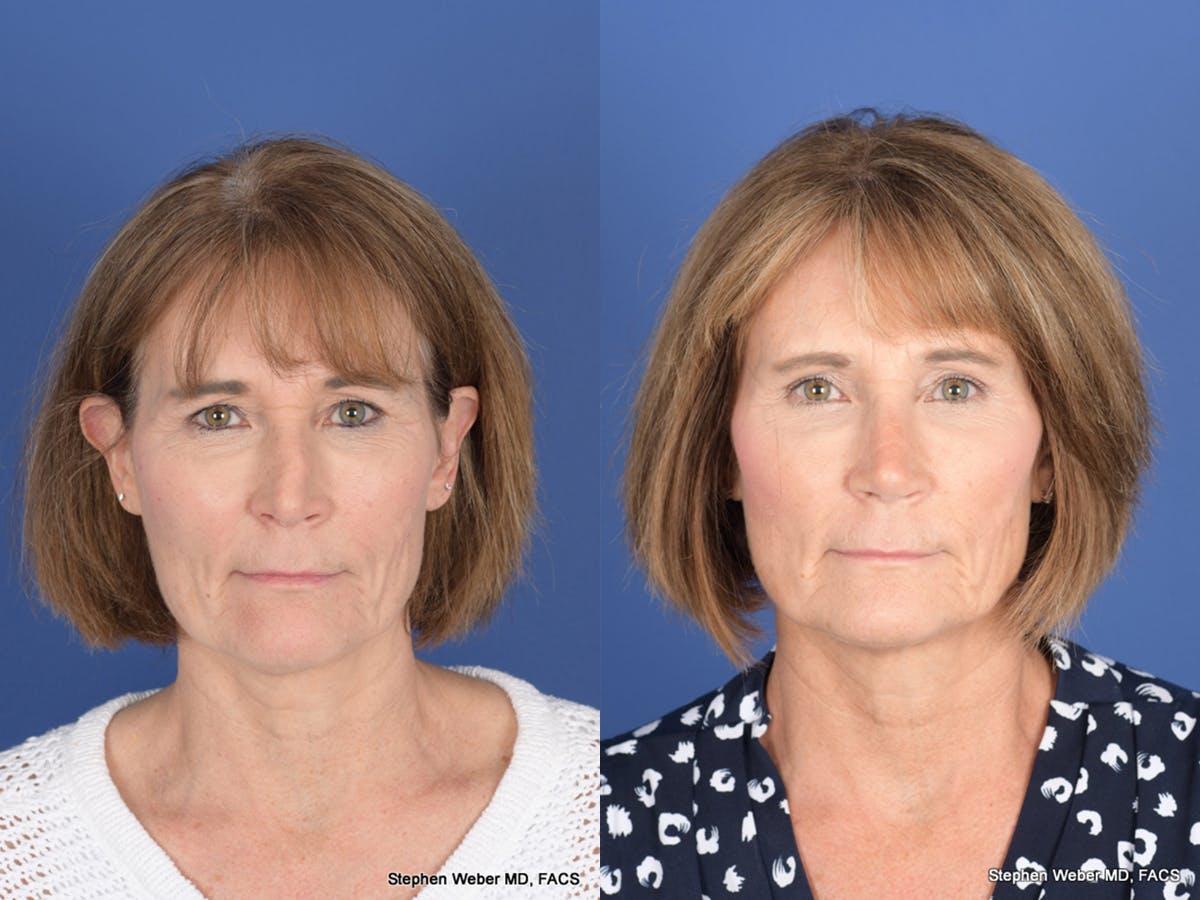 Revision Rhinoplasty Before & After Gallery - Patient 213170 - Image 1