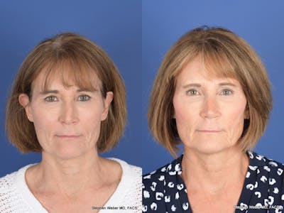Revision Rhinoplasty Before & After Gallery - Patient 213170 - Image 1