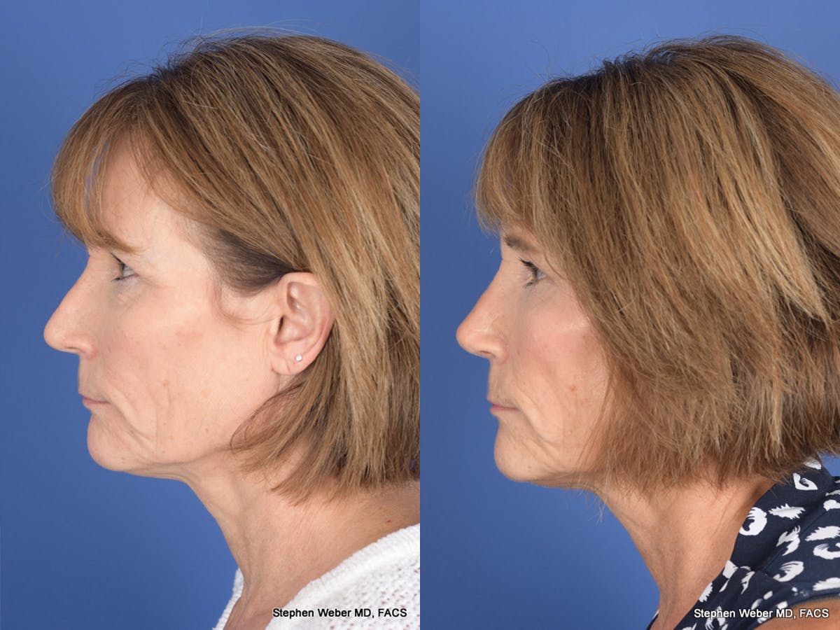 Revision Rhinoplasty Before & After Gallery - Patient 213170 - Image 2