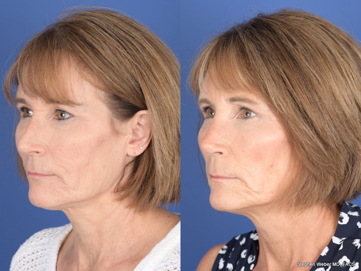 Revision Rhinoplasty Before & After Gallery - Patient 213170 - Image 3