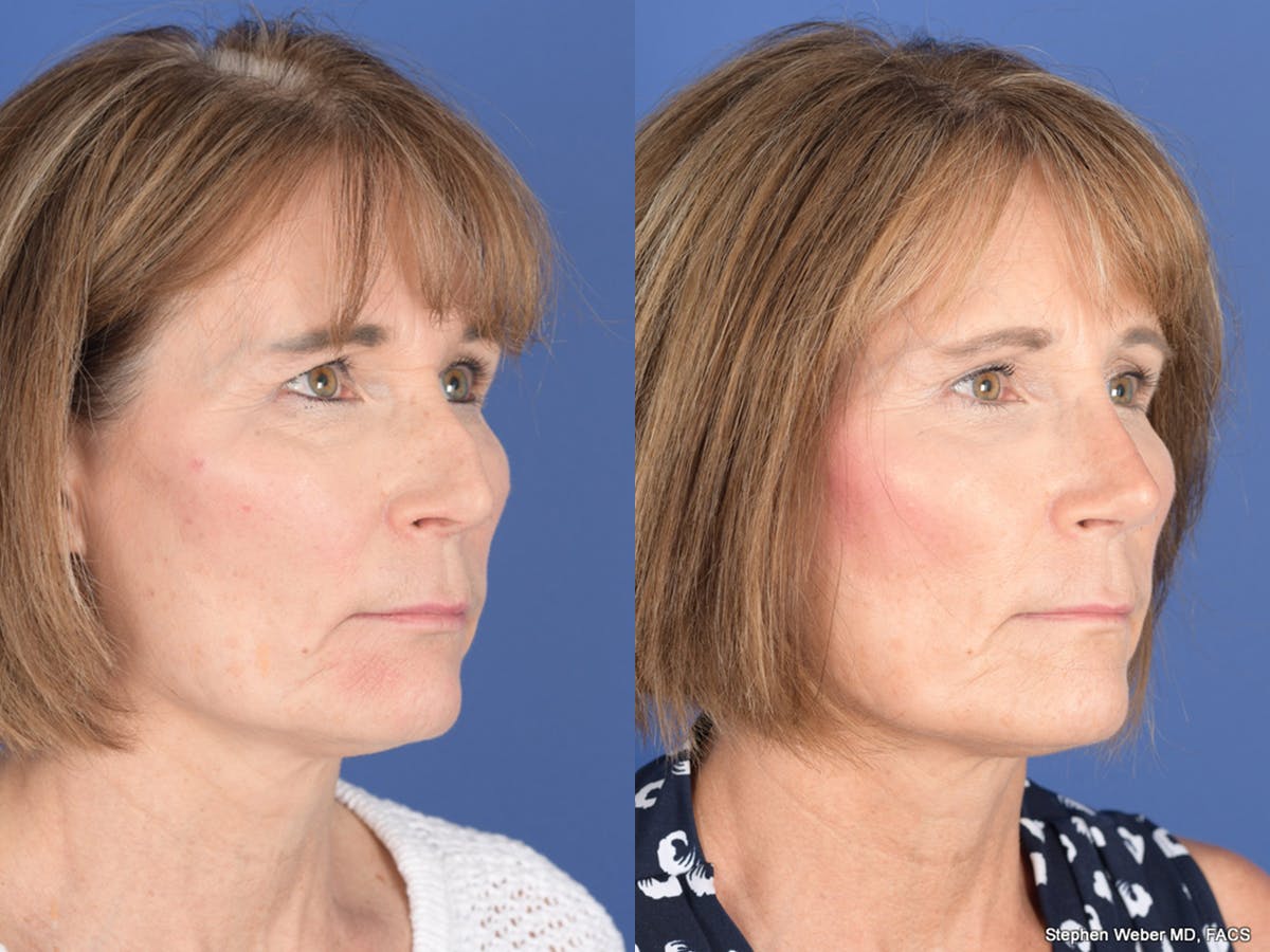 Revision Rhinoplasty Before & After Gallery - Patient 213170 - Image 4
