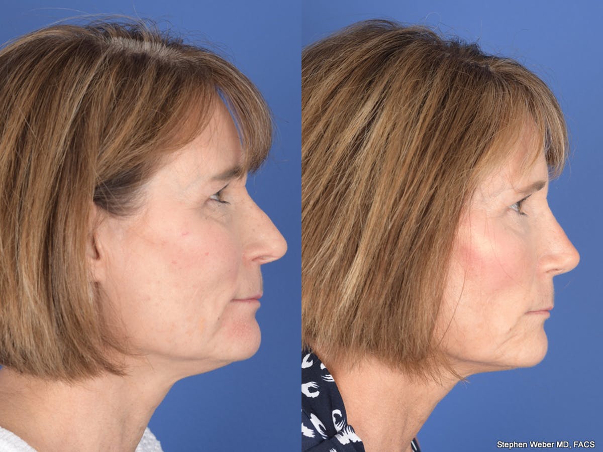 Revision Rhinoplasty Before & After Gallery - Patient 213170 - Image 5