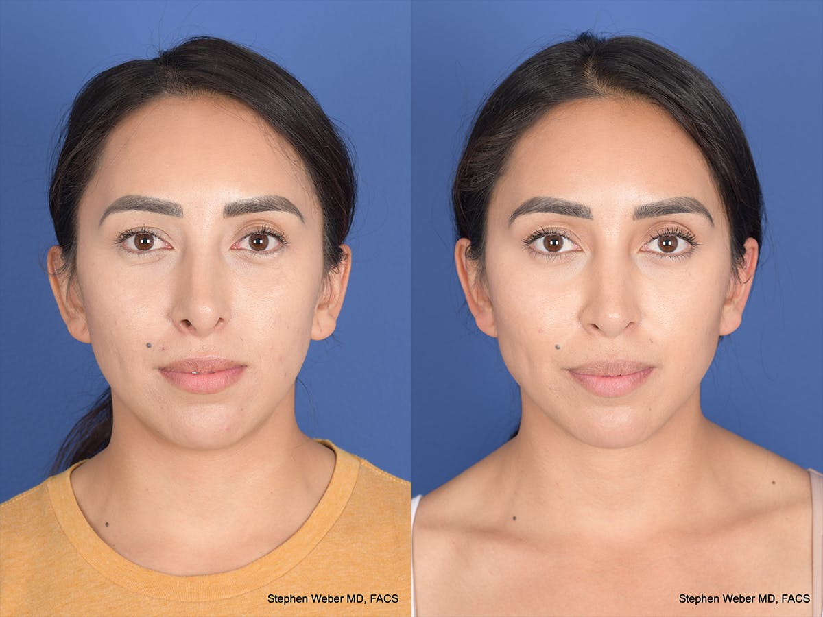 Revision Rhinoplasty Before & After Gallery - Patient 166153 - Image 1
