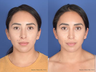 Revision Rhinoplasty Before & After Gallery - Patient 166153 - Image 1