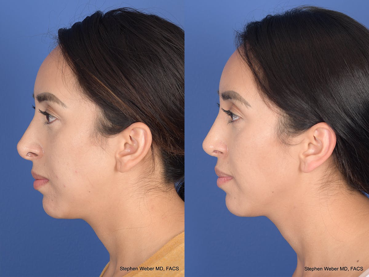 Revision Rhinoplasty Before & After Gallery - Patient 166153 - Image 2