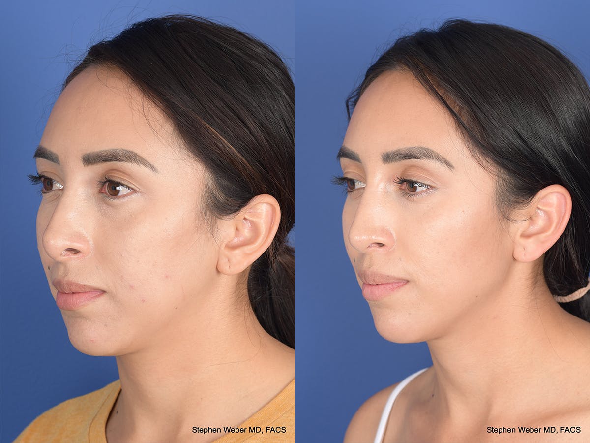 Revision Rhinoplasty Before & After Gallery - Patient 166153 - Image 3