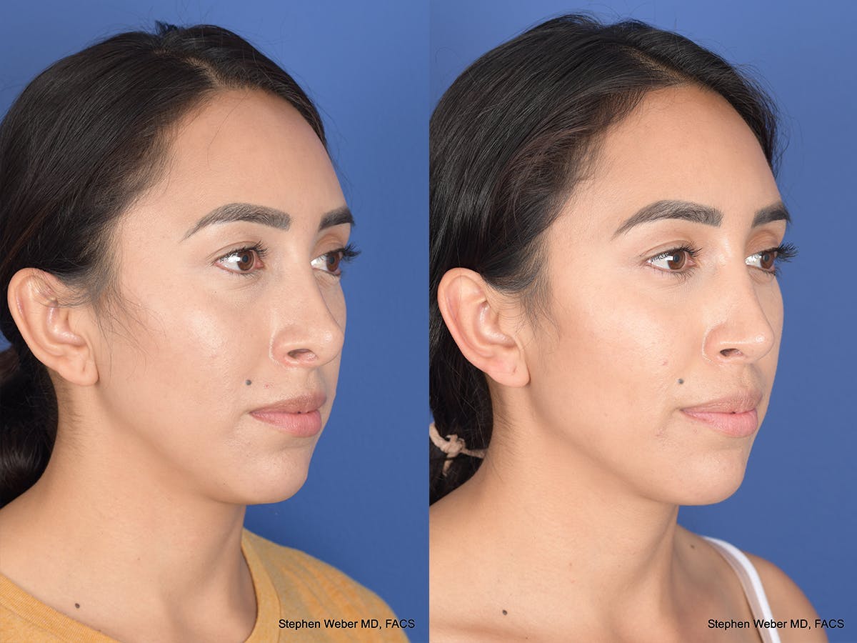 Revision Rhinoplasty Before & After Gallery - Patient 166153 - Image 4