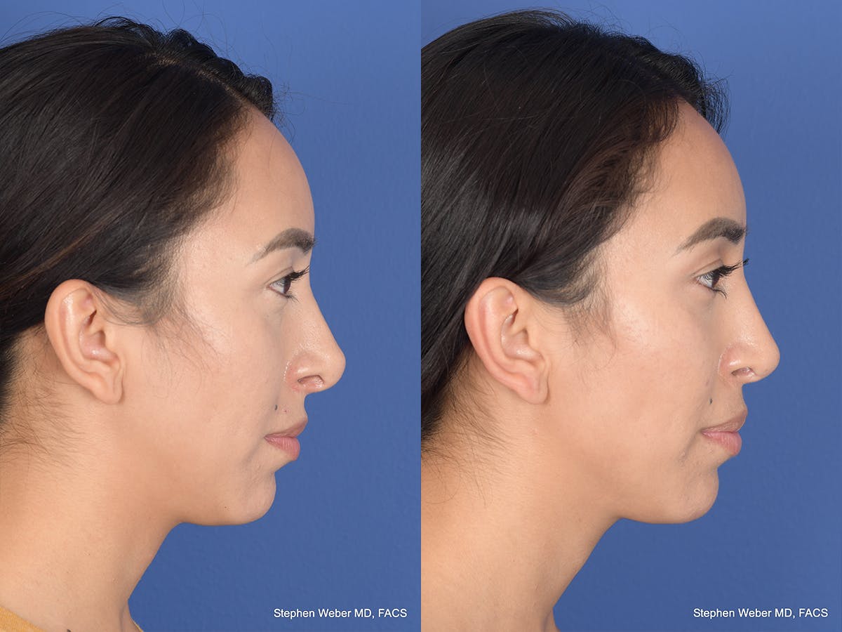 Revision Rhinoplasty Before & After Gallery - Patient 166153 - Image 5