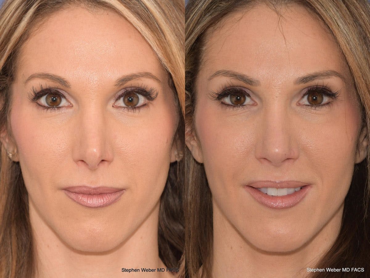 Revision Rhinoplasty Before & After Gallery - Patient 101595 - Image 1