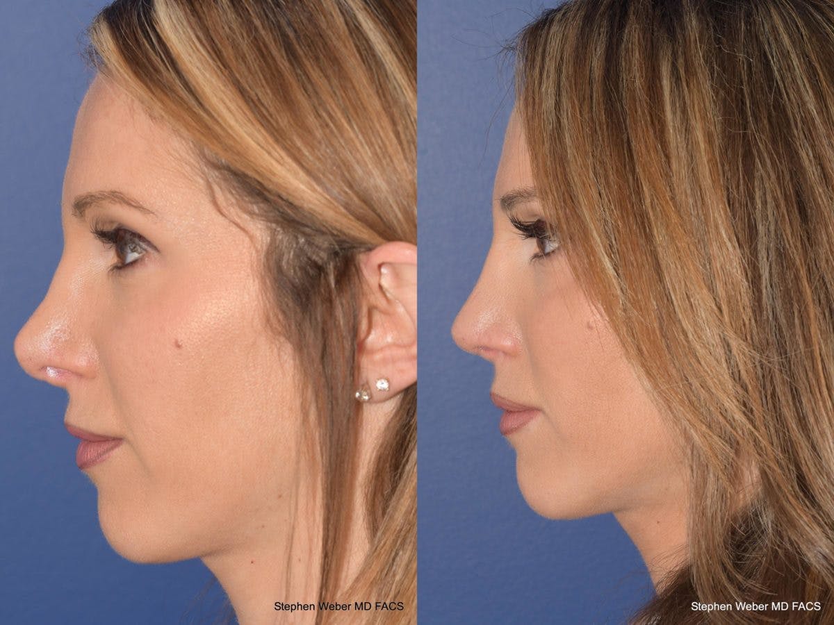Revision Rhinoplasty Before & After Gallery - Patient 101595 - Image 2
