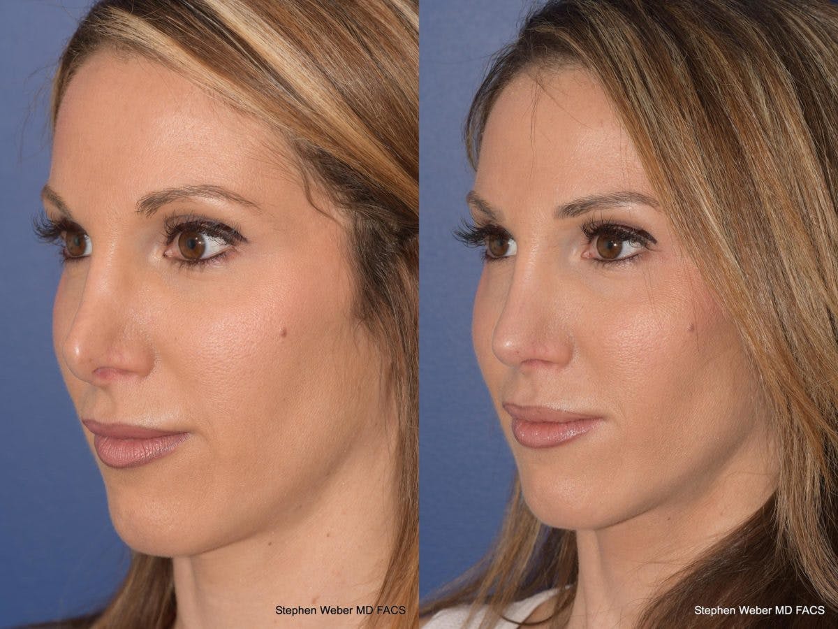 Revision Rhinoplasty Before & After Gallery - Patient 101595 - Image 3