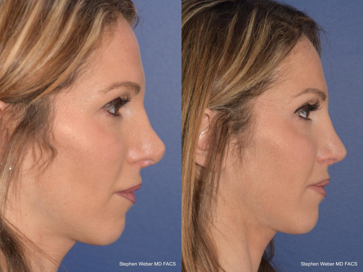 Revision Rhinoplasty Before & After Gallery - Patient 101595 - Image 4