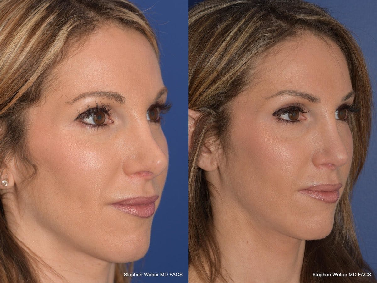 Revision Rhinoplasty Before & After Gallery - Patient 101595 - Image 5