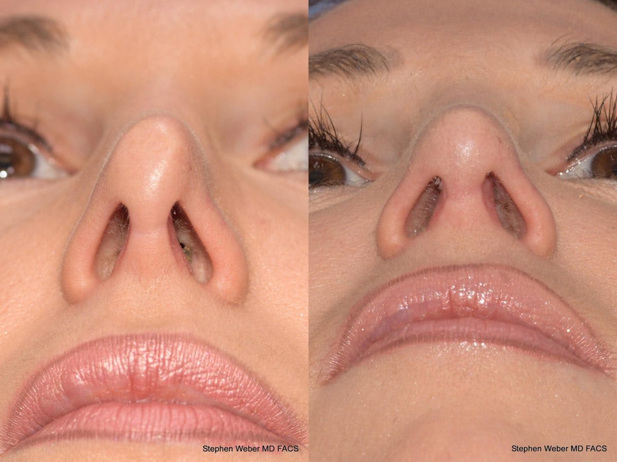 Revision Rhinoplasty Before & After Gallery - Patient 101595 - Image 6