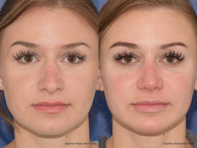 Revision Rhinoplasty Before & After Gallery - Patient 357370 - Image 1