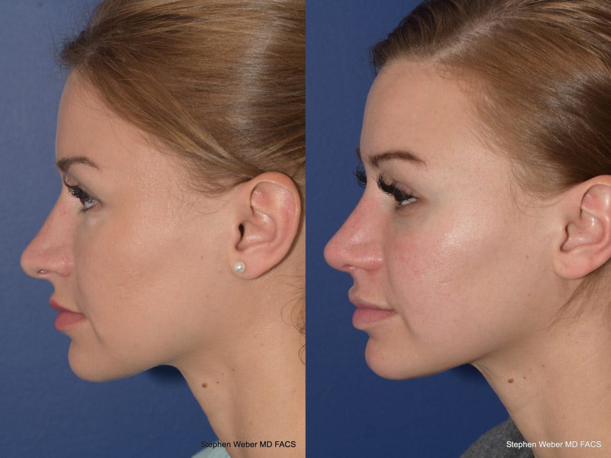 Rhinoplasty Before & After Gallery - Patient 128904 - Image 2