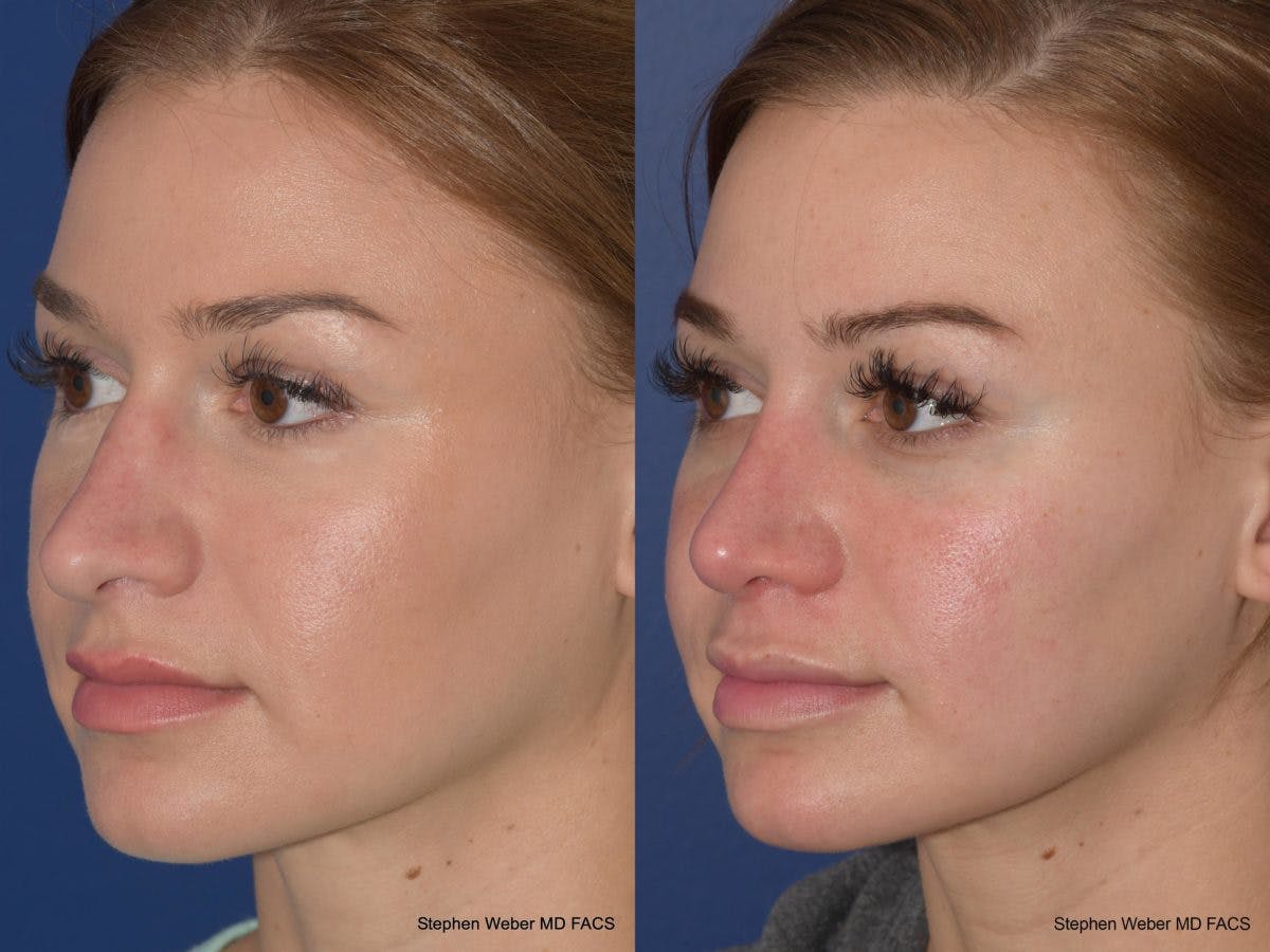Rhinoplasty Before & After Gallery - Patient 128904 - Image 3