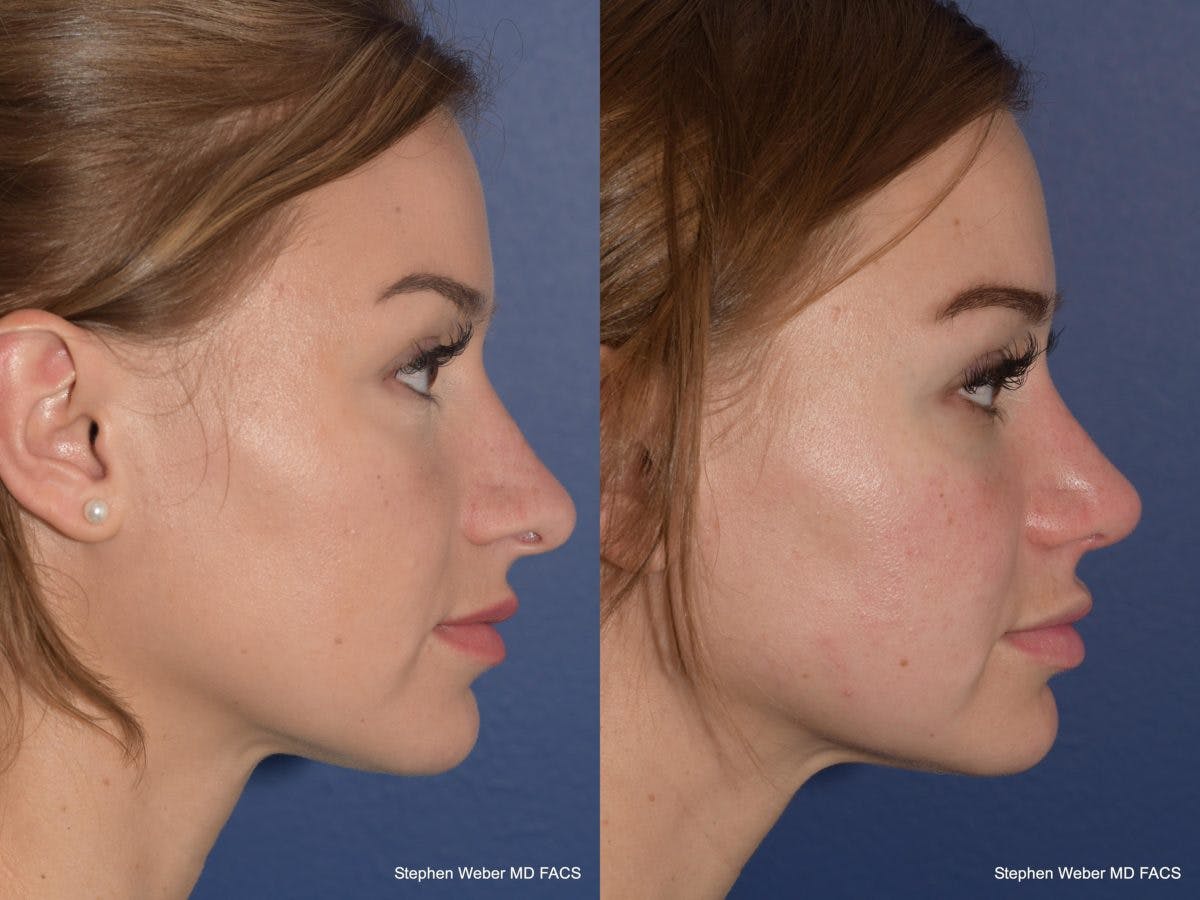 Rhinoplasty Before & After Gallery - Patient 128904 - Image 4