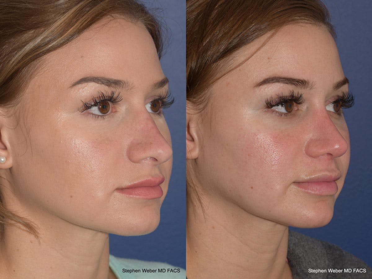 Rhinoplasty Before & After Gallery - Patient 128904 - Image 5