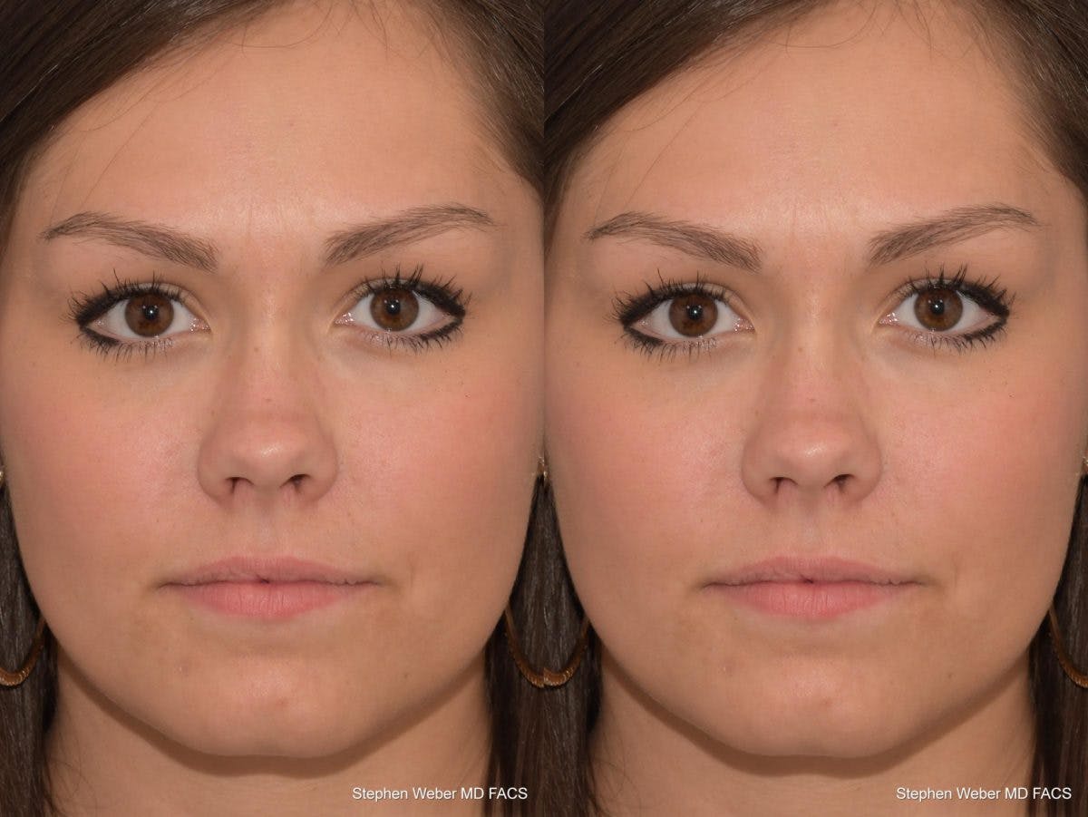 Revision Rhinoplasty Before & After Gallery - Patient 168765 - Image 1