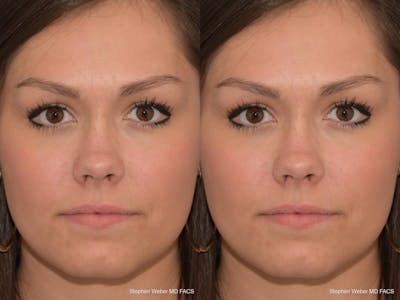 Revision Rhinoplasty Before & After Gallery - Patient 168765 - Image 1