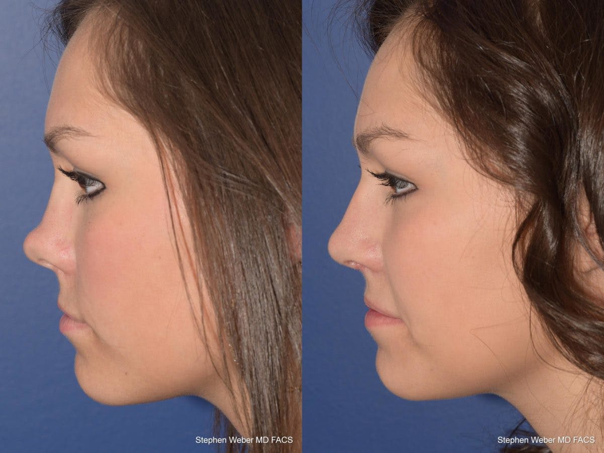 Revision Rhinoplasty Before & After Gallery - Patient 168765 - Image 2
