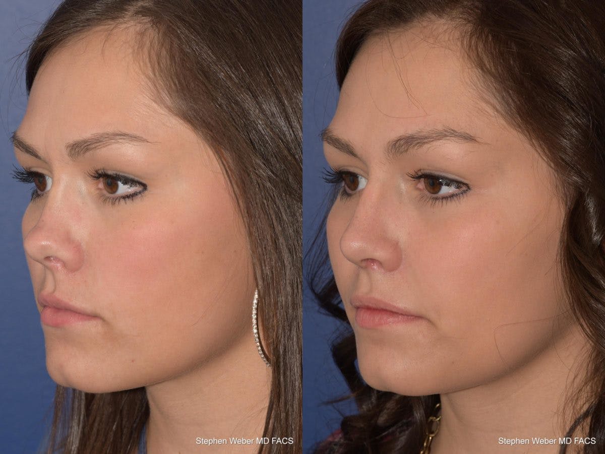 Revision Rhinoplasty Before & After Gallery - Patient 168765 - Image 3