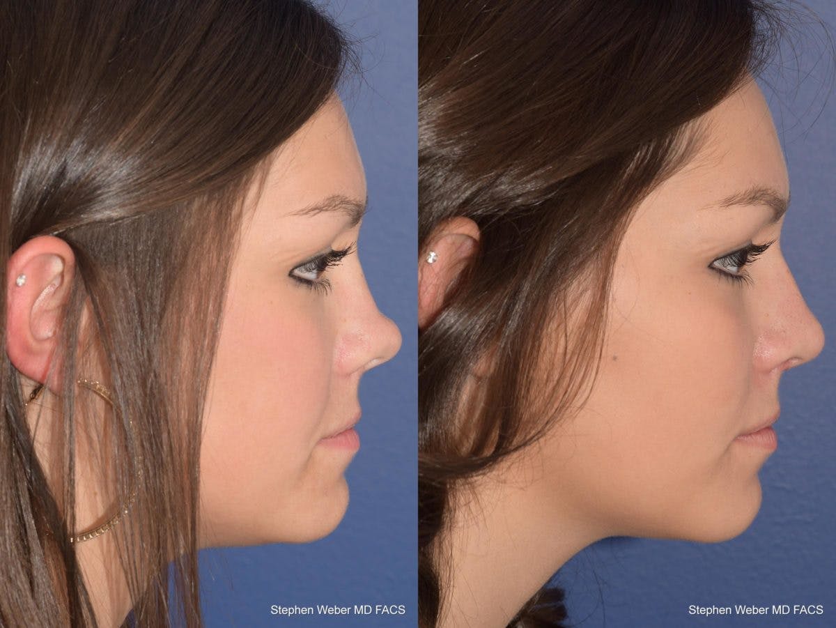 Revision Rhinoplasty Before & After Gallery - Patient 168765 - Image 4